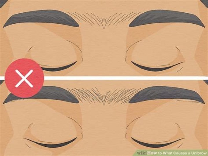 What causes a unibrow?
