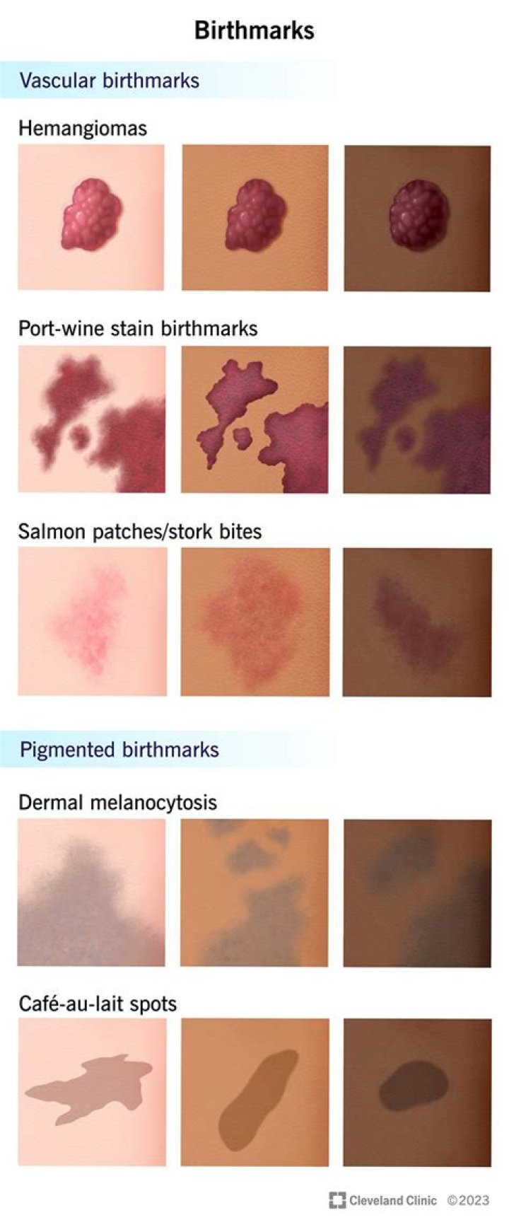 What causes black birthmarks?