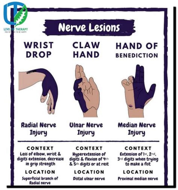 What causes drop wrist?