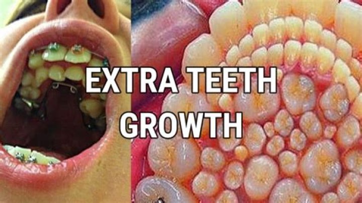 What causes extra gum growth?