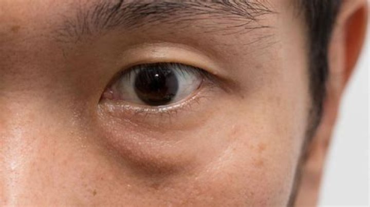 What causes panda eyes?