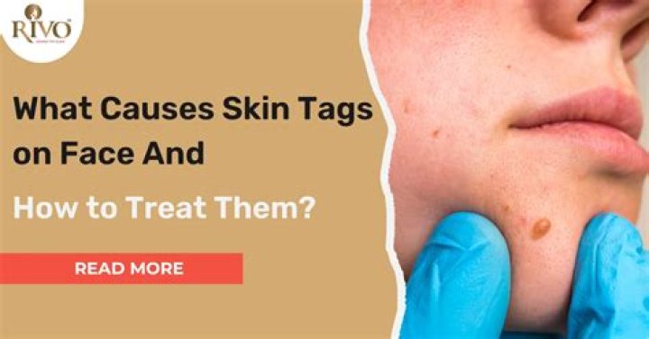 What causes skin tags to form?