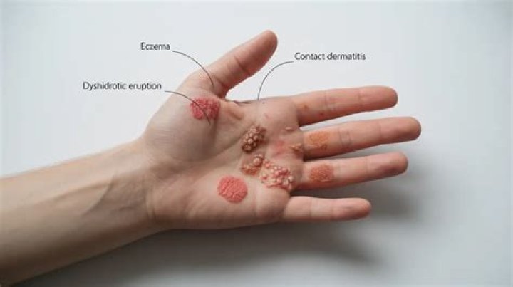 What causes small bumps in the palm of your hand?