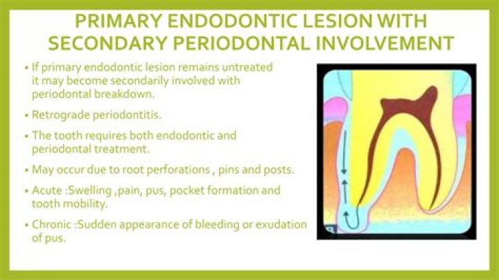 What causes sudden periodontitis?
