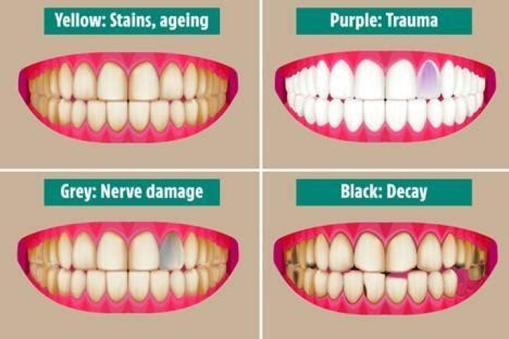 What colour should teeth be?