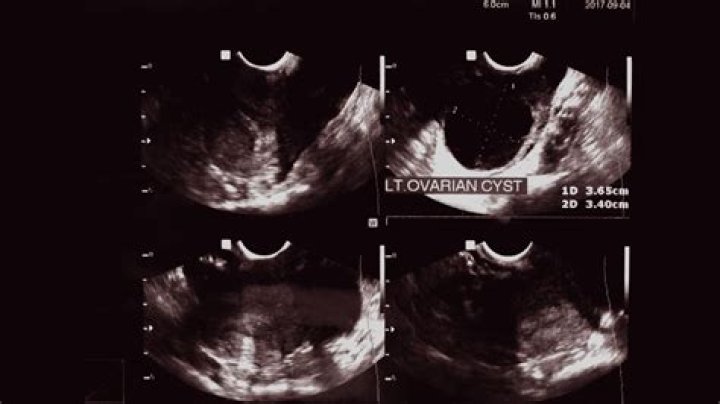 What comes out of a cyst when you squeeze it?