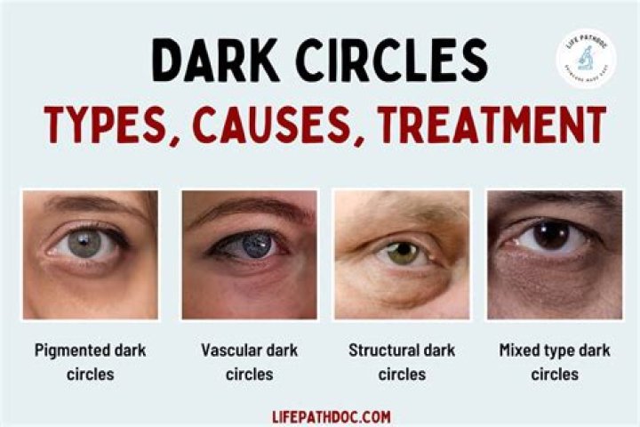 What deficiency causes dark circles?