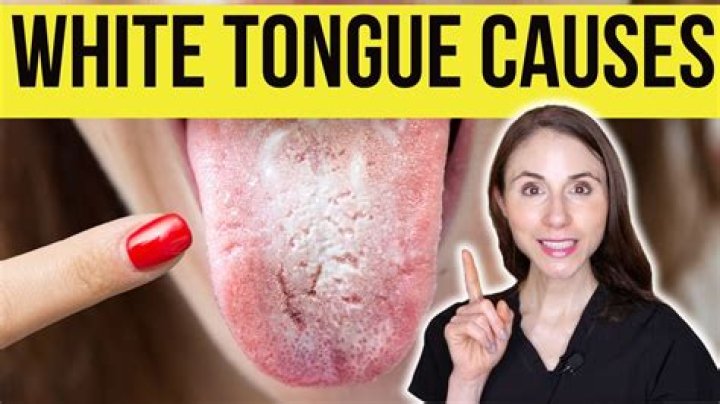 What deficiency causes white tongue?