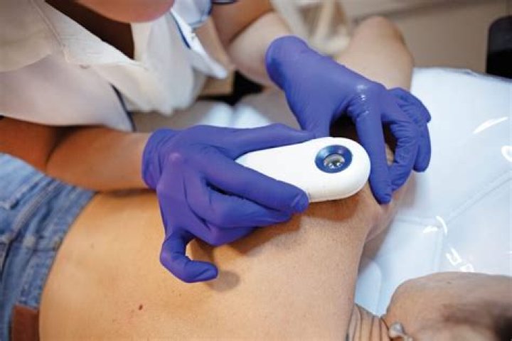What do dermatologists say about pore vacuums?