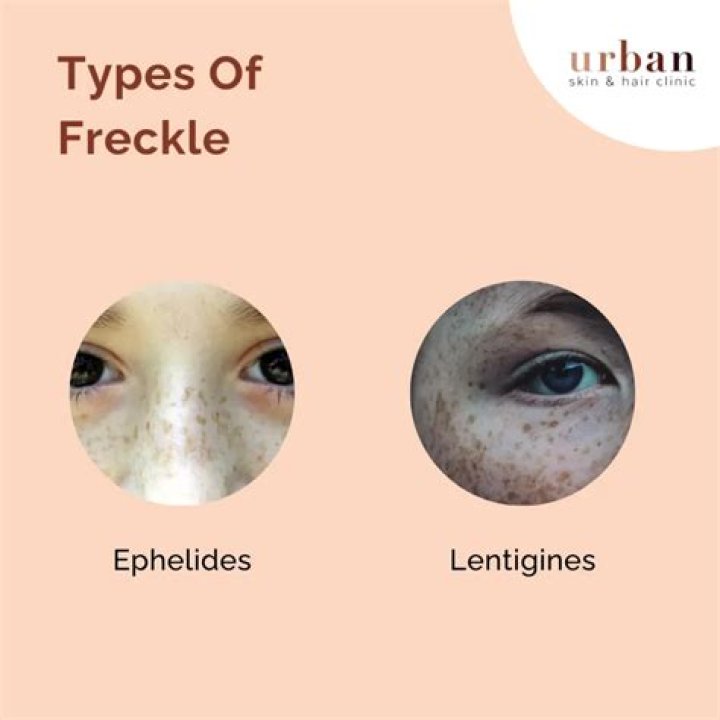 What do freckles symbolize?