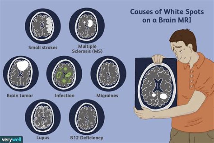 What do white spots on brain MRI mean?