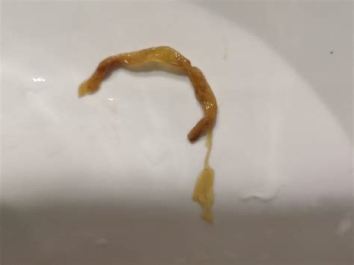 What do worms look like in human poop?