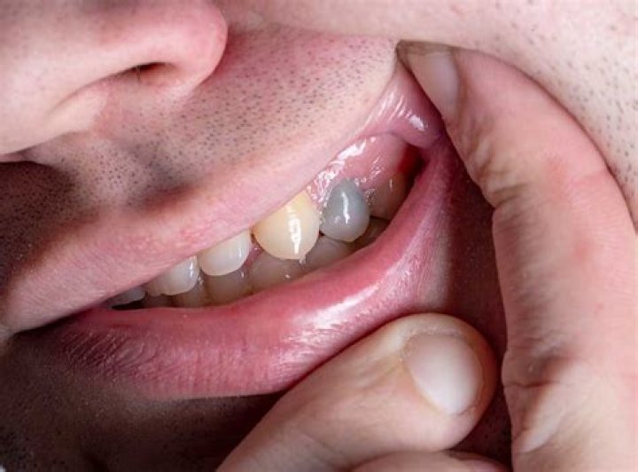What does a dying tooth root feel like?