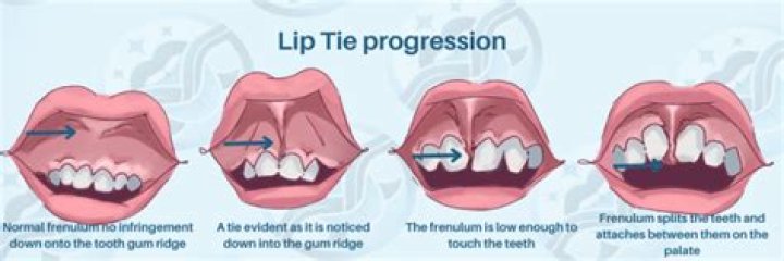 What does a lip tie look like?
