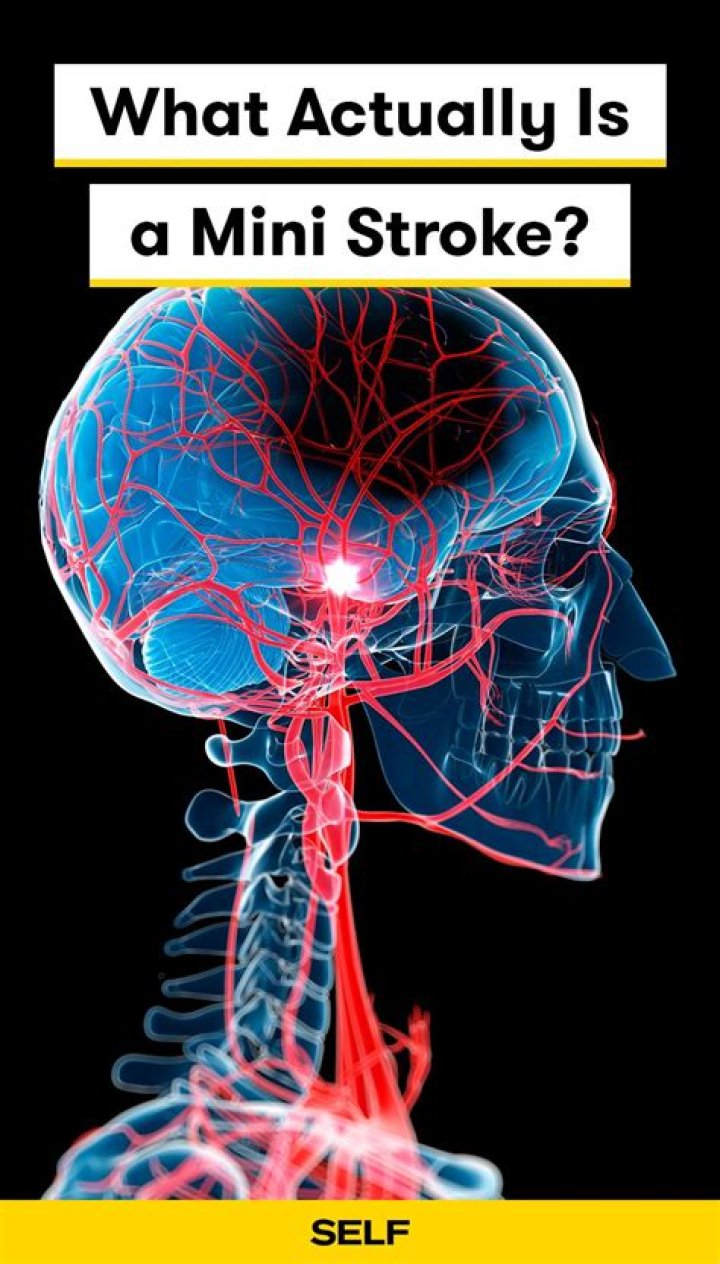 What does a mini stroke look like?