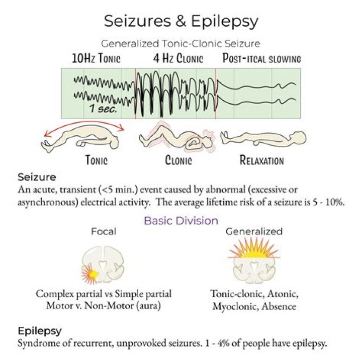 What does a non epileptic seizure look like?