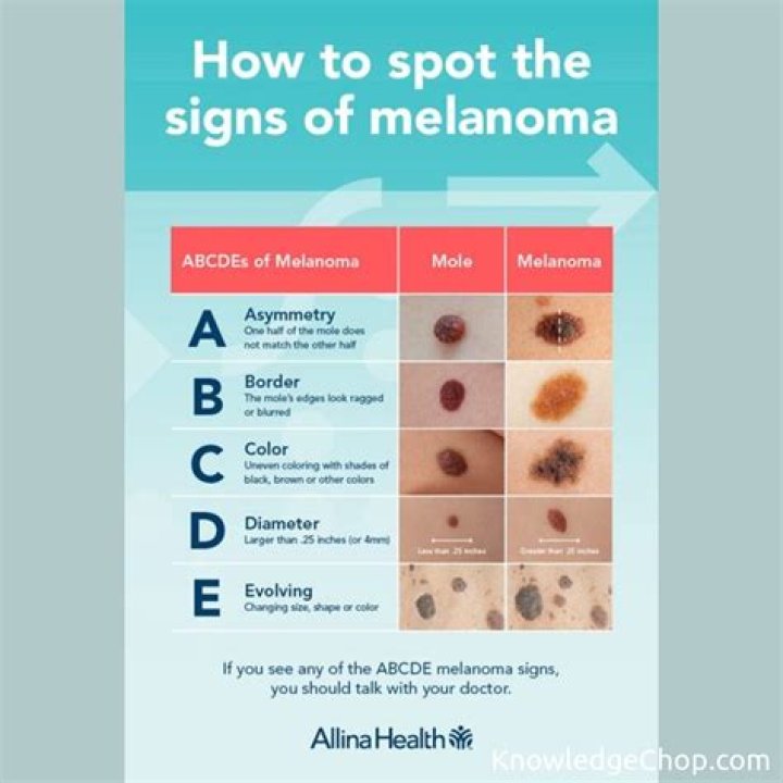 What does a non mole melanoma look like?