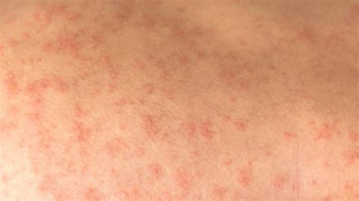 What does a parasite rash look like?