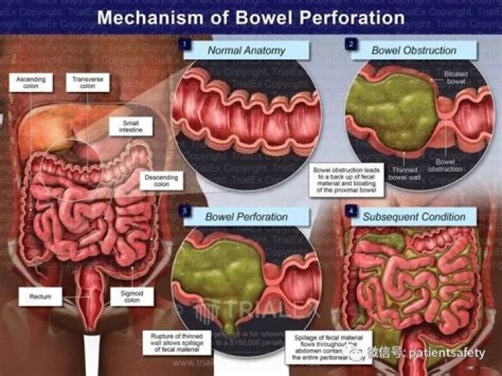 What does a perforated bowel feel like?