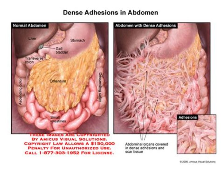 What does adhesions look like?