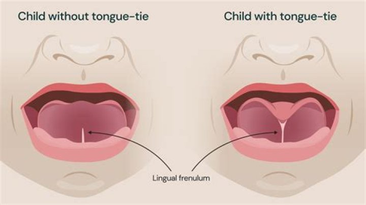 What does adult tongue-tie look like?