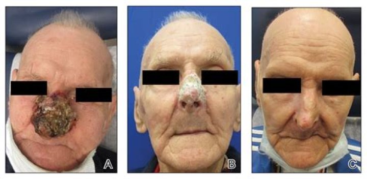 What does advanced basal cell carcinoma look like?
