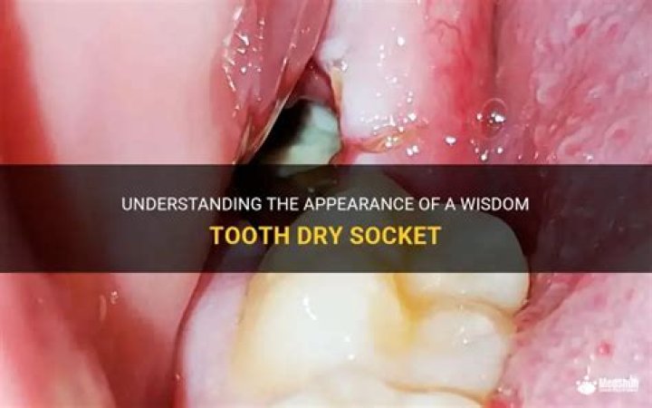 What does dry socket look like wisdom teeth?