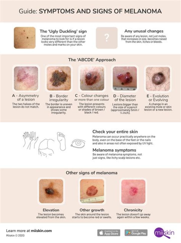 What does early signs of melanoma look like?