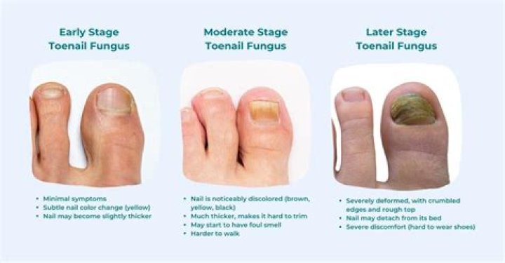 What does fungus between toes look like?