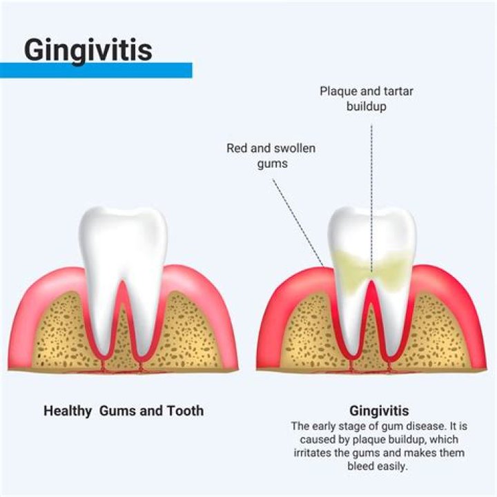 What does gingivitis pain feel like?
