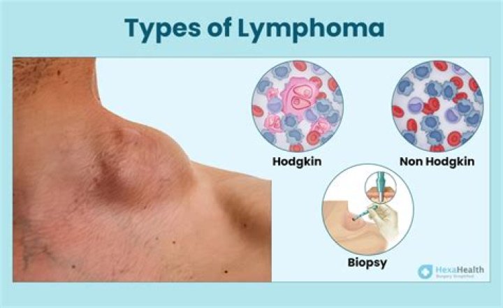 What does lymphoma look like on neck?
