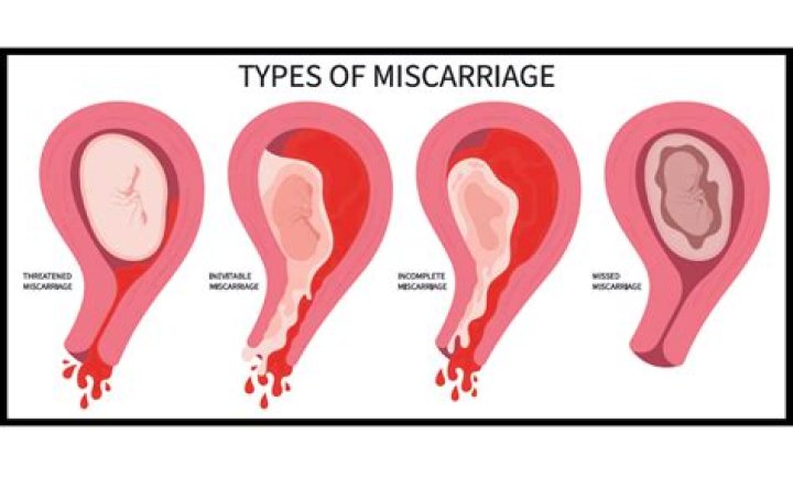 What does miscarriage blood look like?