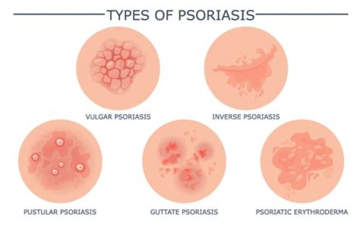 What does psoriasis look like?