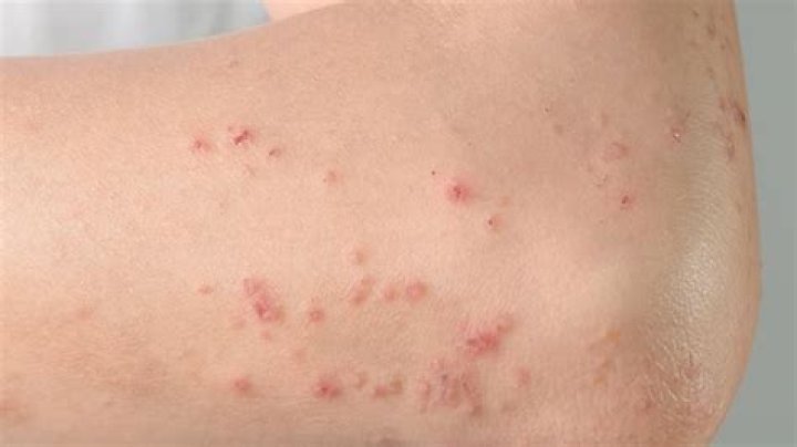 What does skin eating bacteria look like?