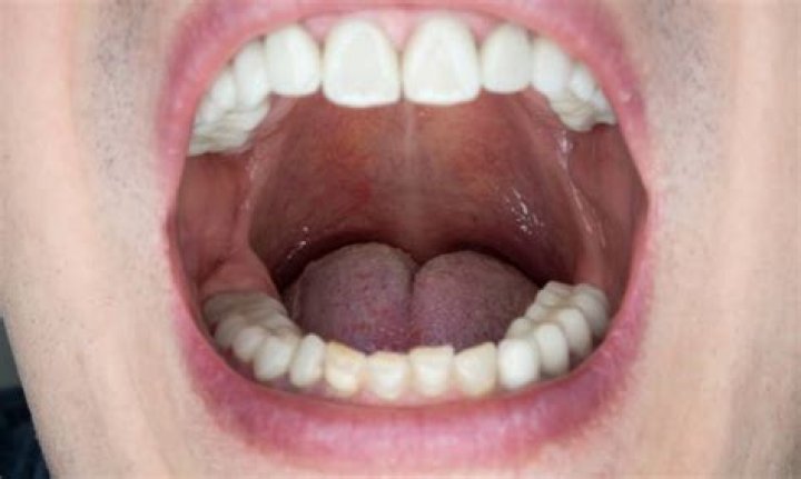 What does thrush in the mouth look like?