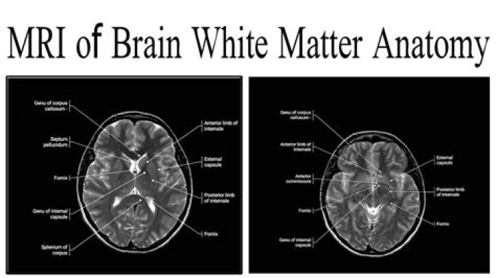 What does white matter on brain MRI mean?