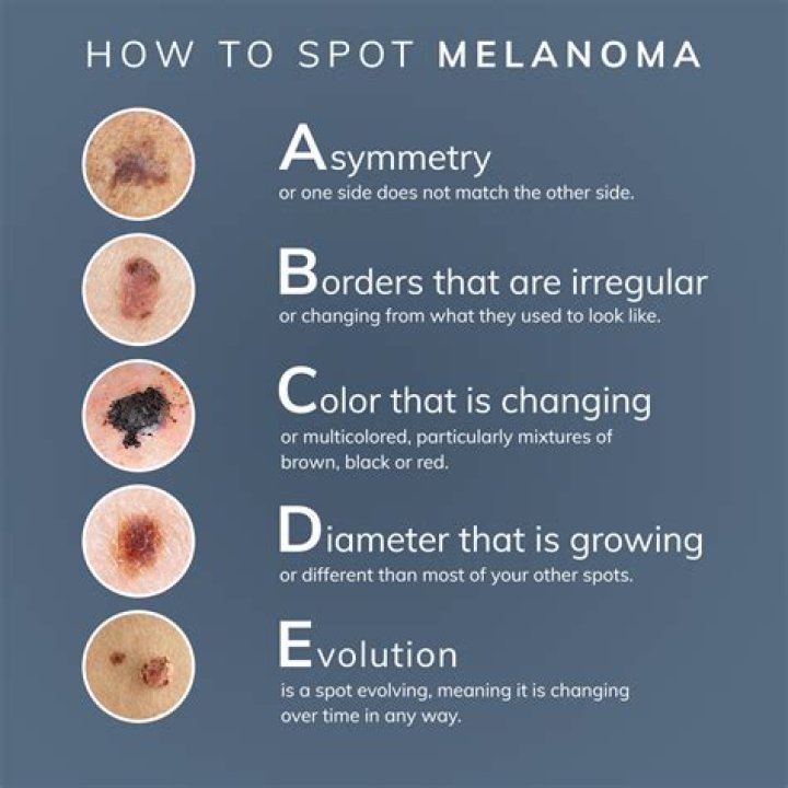 What happens after a melanoma is removed?