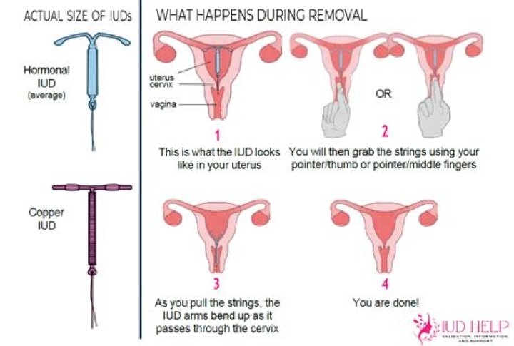 What happens after you remove IUD?