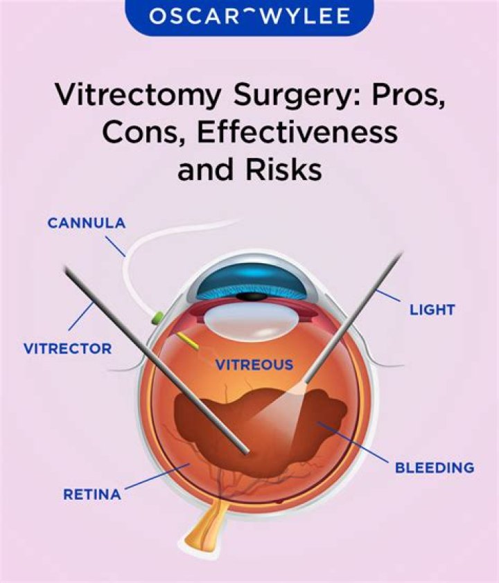 What happens if a vitrectomy doesn't work?
