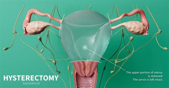 What happens if my cervix is removed?