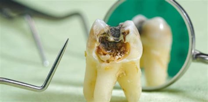 What happens if you don't get a rotten tooth pulled?