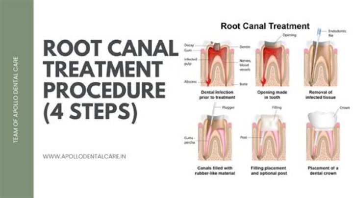 What happens if you get a filling instead of a root canal?