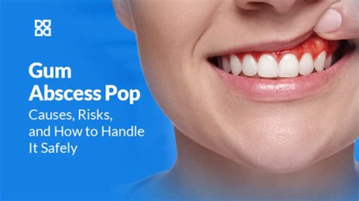 What happens if you pop an abscess?