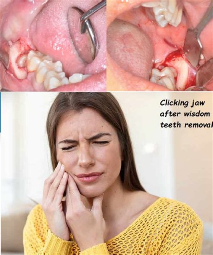 What happens if your wisdom teeth rot?