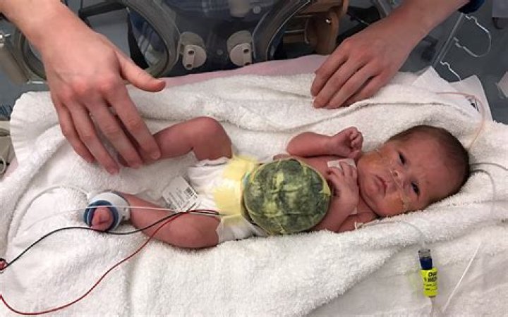 What happens when a baby is born with organs outside the body?