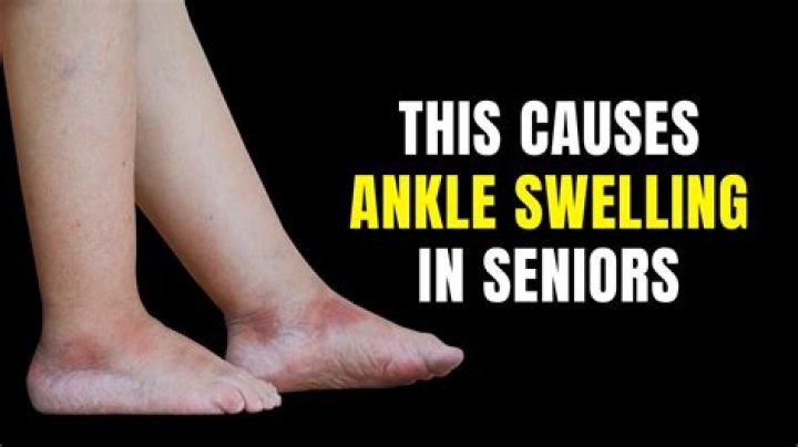 What helps with swollen legs in elderly?