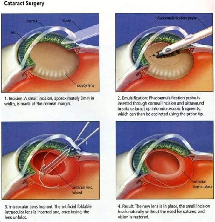 What holds new lens in place after cataract surgery?