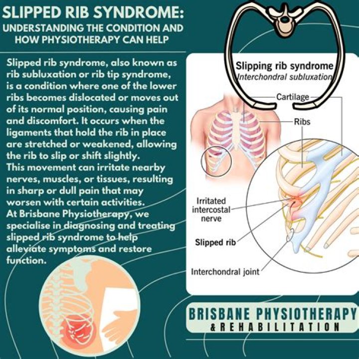What is 12th rib syndrome?