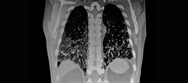 What is a CT scan used for lungs?