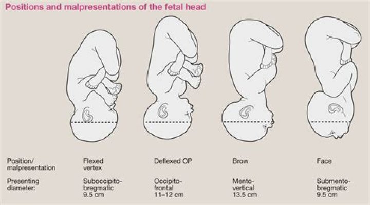 What is a Malpositioned baby?